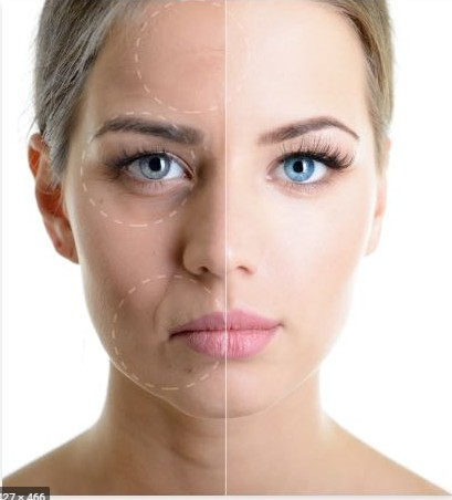 Botox treatment